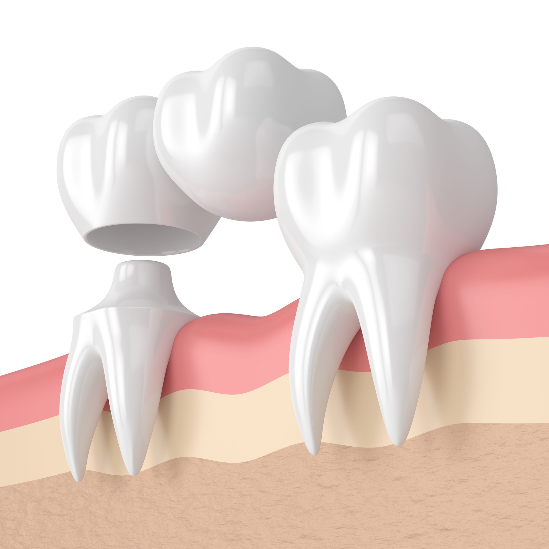 3d render of teeth with dental cantilever bridge